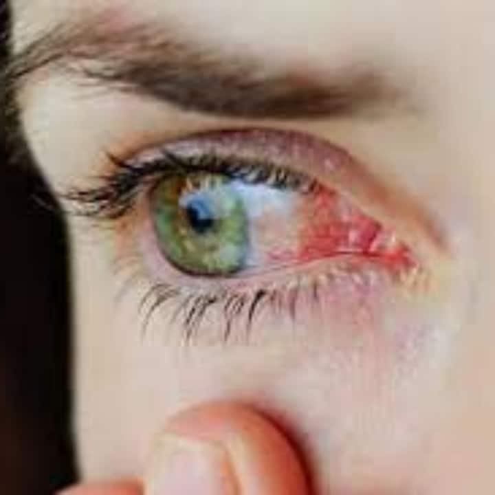 কঞ্জাঙ্কটিভাইটিসকে অনেকেই  pink eye বলে থাকেন। বছরের যে কোনও সময়ই এই ইনফেকশন হতে পারে। তবে বর্ষায় বাড়ে প্রকোপ।
