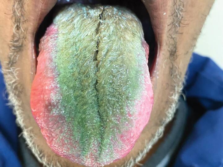 Hairy Tongue Disease Causes Treatment Symptoms America Man Tongue Colour Changed Into Green स्मोकिंग करने वालों हो जाओ सावधान, वरना जीभ का हो सकता है इतना बुरा अंजाम, जानें क्या है ये बीमारी