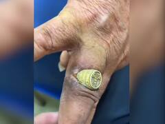 'टाइट रिंग' पहनने से शख्स का हुआ बुरा हाल, उंगली को काटकर अंदर जा घुसी अंगूठी, देखें Video