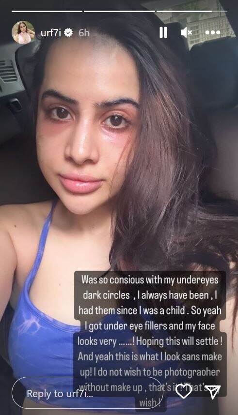 Uorfi Javed Regrets Getting Under-Eye Fillers After Getting Trolled: ‘Why Did I Do This To Myself?’
