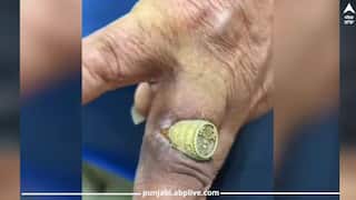 'ਟਾਈਟ ਰਿੰਗ' ਪਹਿਨਣ ਨਾਲ ਵਿਅਕਤੀ ਦਾ ਹੋਇਆ ਬੁਰਾ ਹਾਲ, ਉਂਗਲੀ ਨੂੰ ਕੱਟ ਕੇ ਅੰਦਰ ਵੜ ਗਈ ਮੁੰਦਰੀ, ਦੇਖੋ ਵੀਡੀਓ