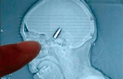 Weird News: ਸਿਰ 'ਚ ਲੱਗੀ ਗੋਲੀ ਤੇ ਵਿਅਕਤੀ ਨੂੰ ਪਤਾ ਹੀ ਨਾ ਲੱਗਾ! ਮਾਮਲਾ ਦੇਖ ਕੇ ਡਾਕਟਰਾਂ ਵੀ ਘਬਰਾ ਗਏ headache turned out to be bullet hole in back of mans head man shot in head still alive Weird News: ਸਿਰ 'ਚ ਲੱਗੀ ਗੋਲੀ ਤੇ ਵਿਅਕਤੀ ਨੂੰ ਪਤਾ ਹੀ ਨਾ ਲੱਗਾ! ਮਾਮਲਾ ਦੇਖ ਕੇ ਡਾਕਟਰਾਂ ਵੀ ਘਬਰਾ ਗਏ