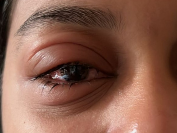 Conjunctivitis Symptoms Causes Treatment Prevention How Eye Flu Infection  Spread | दिल्ली सहित कई राज्यों में फैल रही आंखों की ये बीमारी, क्या है  लक्षण और कारण? कैसे करना है अपना ...