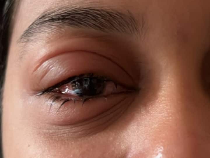 Conjunctivitis Symptoms Causes Treatment Prevention How Eye Flu Infection Spread दिल्ली सहित कई राज्यों में फैल रही आंखों की ये बीमारी, क्या है लक्षण और कारण? कैसे करना है अपना बचाव? जान लें सबकुछ