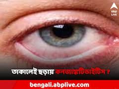 কনজাঙ্কটিভাইটিস আক্রান্তের চোখের দিকে তাকালেই সংক্রমণ ? কী উপায়ে বাঁচবেন ?