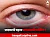 conjunctivitis : কনজাঙ্কটিভাইটিস আক্রান্তের চোখের দিকে তাকালেই সংক্রমণ ? কী উপায়ে বাঁচবেন ?