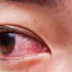 Conjunctivitis কে কেন বলে জয় বাংলা? চশমার আড়াল কি সংক্রমণ আটকাতে পারে ?