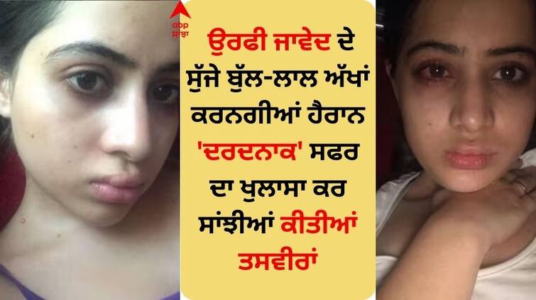 uorfi-javed-painful-journey-of-getting-lip-fillers-shared-photos Uorfi Javed: ਉਰਫੀ ਜਾਵੇਦ ਦੇ ਸੁੱਜੇ ਬੁੱਲ-ਲਾਲ ਅੱਖਾਂ ਕਰਨਗੀਆਂ ਹੈਰਾਨ, 'ਦਰਦਨਾਕ' ਸਫਰ ਦਾ ਖੁਲਾਸਾ ਕਰ ਸਾਂਝੀਆਂ ਕੀਤੀਆਂ ਤਸਵੀਰਾਂ