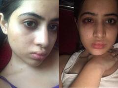 सूजे होंठ-लाल आखें, 18 साल की उम्र से लिप फिलर करवा रही उर्फी जावेद की 'दर्दभरी' जर्नी, Shocking Pics