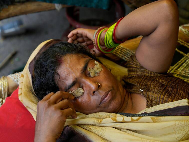 Eye flu cases are increasing continuously from Delhi to Chhattisgarh what are the symptoms and how to prevent Learn from experts abpp दिल्ली से लेकर छत्तीसगढ़ तक लगातार बढ़ रहे Eye Flu के मामले, क्या है लक्षण और कैसे करें बचाव? एक्सपर्ट्स से जानें