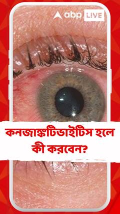 কনজাঙ্কটিভাইটিস হলে কী করবেন?