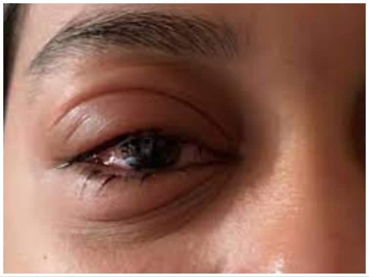 causes of eye flu and common symptoms Eye Flu : கண் எரிச்சலா? சாதாரணமாக நினைத்து அலட்சியப்படுத்த வேண்டாம்.. இந்த அபாயங்கள் இருக்கு..