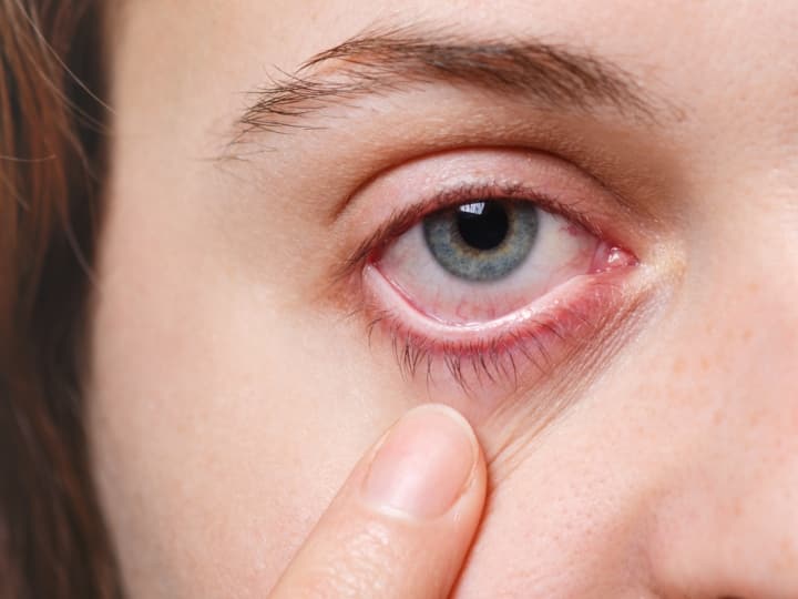 Eye Conjunctivitis  in Nanded district including Latur patients increased लातूरसह नांदेड जिल्ह्यात डोळ्याची साथ; नेत्रविभागात रुग्णांची संख्या वाढली