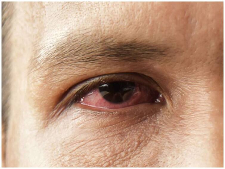 Take these precautions to avoid pink eye infection Pink Eye: పెరిగిపోతున్న కండ్లకలక ఇన్ఫెక్షన్ - ఈ జాగ్రత్తలు తీసుకోండి