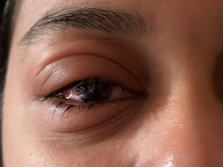Basti Government Schools Many Children infected with Eye Flu Eye Specialist Doctor Advice Patient ann UP News: बस्ती के स्कूलों में बढ़ा आई फ्लू का प्रकोप, जानें- बचने के लिए डॉक्टरों ने क्या दी सलाह?