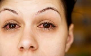 Eye Care: આંખના ઇન્ફેકશનથી બચવાના શું છે ઉપાય, જાણો એક્સપર્ટે શું આપી સલાહ