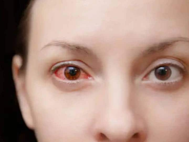 conjunctivitis cases rise in india how to prevent its spread आंख आने वालों की आंख में देखने से फैलती है कंजंक्टिवाइटिस, जानें यह झूठा भ्रम है या सच?