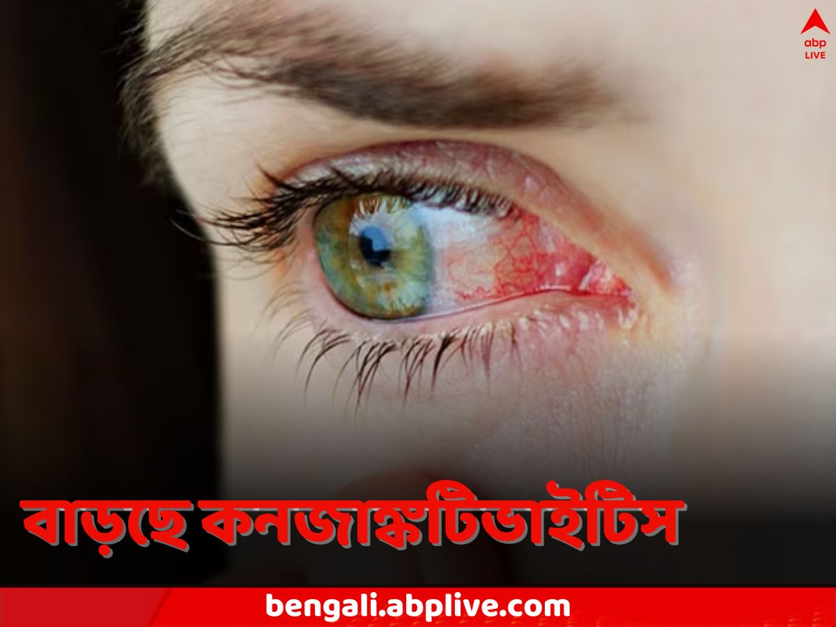 Conjunctivitis in Delhi: রোজ কমপক্ষে ১০০ রোগী AIIMS-এ, দিল্লিতে উত্তরোত্তর বাড়ছে কনজাঙ্কটিভাইটিস, কী করণীয় জানালেন চিকিৎসকেরা