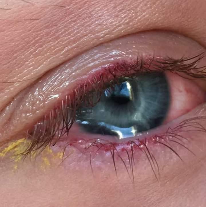 डोळे आल्यास काय काळजी घ्यावी हे जाणून घेऊया.