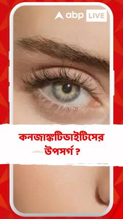 কনজাঙ্কটিভাইটিসের উপসর্গ ? দ্রুত চিকিৎসা শুরু করার পরামর্শ চিকিৎসকের