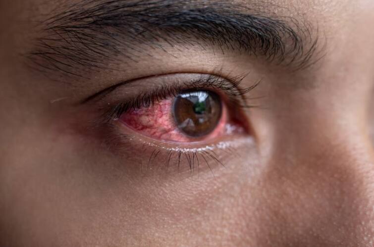 aurangabad news  Conjunctivitis eye disease Avoid using steroid eye drops Conjunctivitis : डोळ्याची साथ सुरु आहे, मग 'हे' औषध घेण्याचे टाळा; आरोग्य विभागाने केलं आवाहन