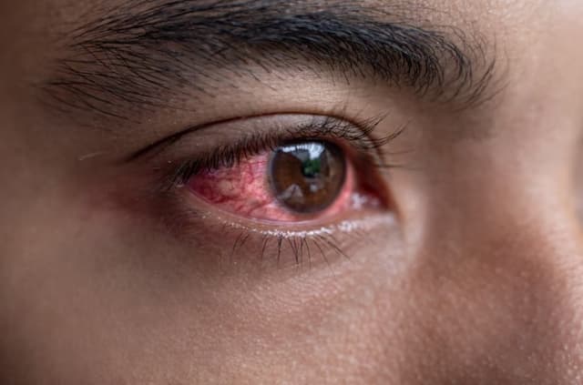 aurangabad news Conjunctivitis eye disease Avoid using steroid eye drops |  Conjunctivitis : डोळ्याची साथ सुरु आहे, मग 'हे' औषध घेण्याचे टाळा; आरोग्य  विभागाने केलं आवाहन