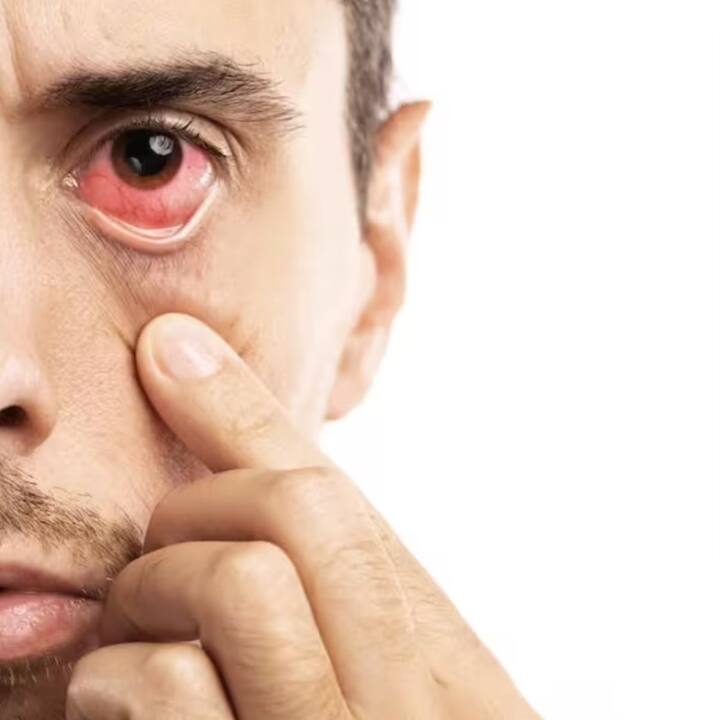 दरम्यान डोळ्यांचा संसर्ग वाढत असल्याचे नागरिकांनी घाबरुन न जाता योग्य ती काळजी घ्यावी, असं आवाहन करण्यात येत आहे.