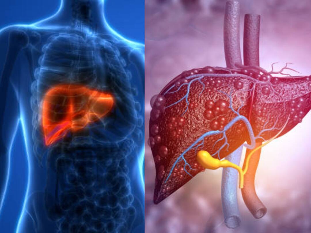 World Hepatitis Day: கொடிய நோயாக உருவெடுக்கும் கல்லீரல் அழற்சி நோய்.. தற்காத்துக்கொள்ள என்னென்ன வழிகள்?