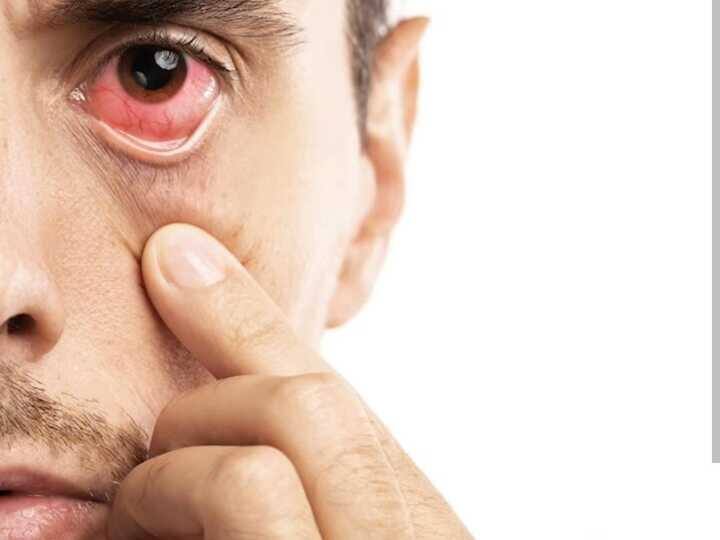 Can eye flu be caused just by looking into the eyes of an infected person Know the opinion of the expert क्या सिर्फ इंफेक्टेड व्यक्ति के आंखों में देखने से भी हो सकता है आई फ्लू? जानिए एक्सपर्ट की राय