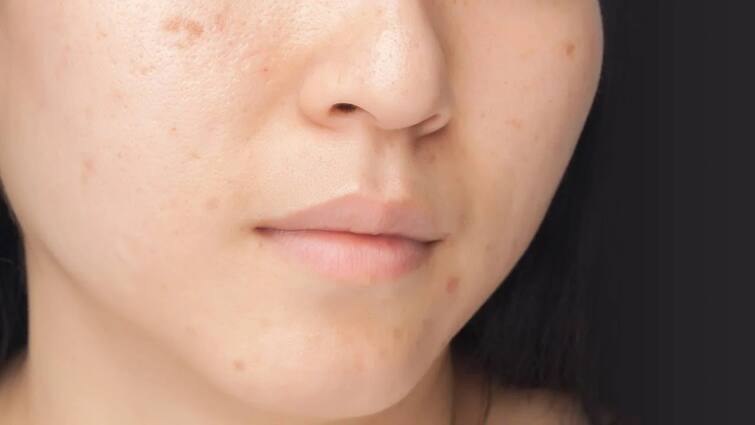 if you are suffring from dark spot on face try these home remedy Skin Care: ચહેરા પરના  જિદ્દી ડાઘથી પરેશાન છો? આ સરળ અને સસ્તા ઉપાયથી ગજબ મળશે રિઝલ્ટ