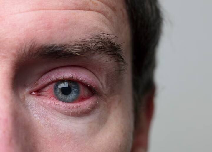 हा आजार संसर्गजन्य असल्याने इतरांना अधिक काळजी घेणं गरजेचं आहे.