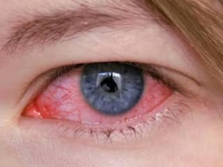 Eye Flu: જો તમારી આંખમાં આ સમસ્યાઓ હોય તો થઈ જાઓ સાવધાન, આંખના ફ્લૂના લક્ષણો હોય શકે 