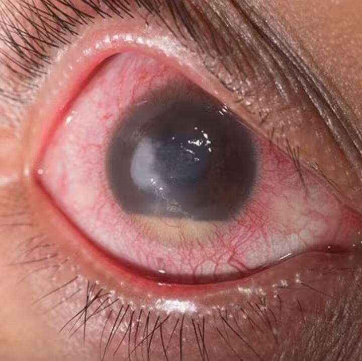 संसर्ग झाल्यास डोळ्यांना स्वच्छ पाण्याने सतत धुवावेत. दुसऱ्यांचा रुमाल, टॉवेल, कपड्यांनी डोळे पुसू नये