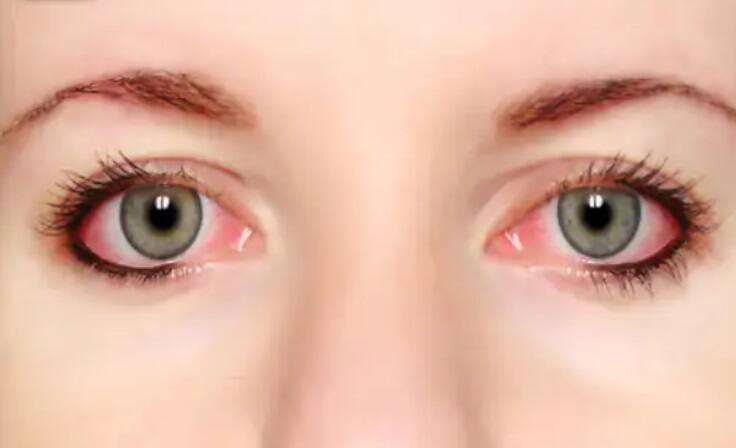 Because of this the   virus   eye infection is spreading, AIIMS research made revelations Health Alert : આંખમાં ઇન્ફેકશન  કરતો આ વાયરસ આંખની  સાથે  ફેફસાને પણ કરે છે ડેમેજ, સાવધાન