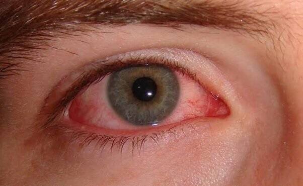 Eye Flu: This eye disease is increasing in the country, have you also come under its grip? Find out what they say Eye Flu: દેશમાં સતત વધી રહી છે આંખની આ બીમારી, શું તમે પણ આવ્યા છો તેની ઝપેટમાં? જાણો શું કહે છે એક્સપર્ટ  