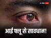 Eye Flu: जांजगीरी-चाम्पा के अस्पतालों में लग रही मरीजों की कतारें, ओपीडी में तीन गुना बढ़ी आई-फ्लू मरीजों की संख्या