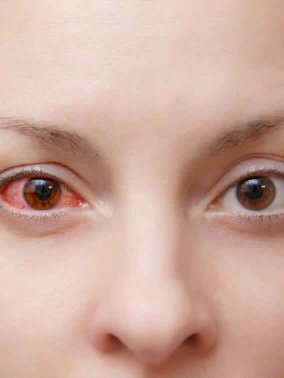 आई फ्लू से बचने के लिए खाएं ये सुपरफूड्स