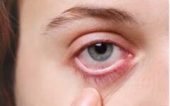 ਜੇ ਵੇਲੇ ਸਿਰ ਗ਼ੌਰ ਨਾ ਕੀਤੀ ਤਾਂ ਘਾਤਕ ਹੋ ਸਕਦਾ EYE ਫਲੂ, ਜਾਣੋ ਬਚਾਅ ਦੇ ਤਰੀਕੇ