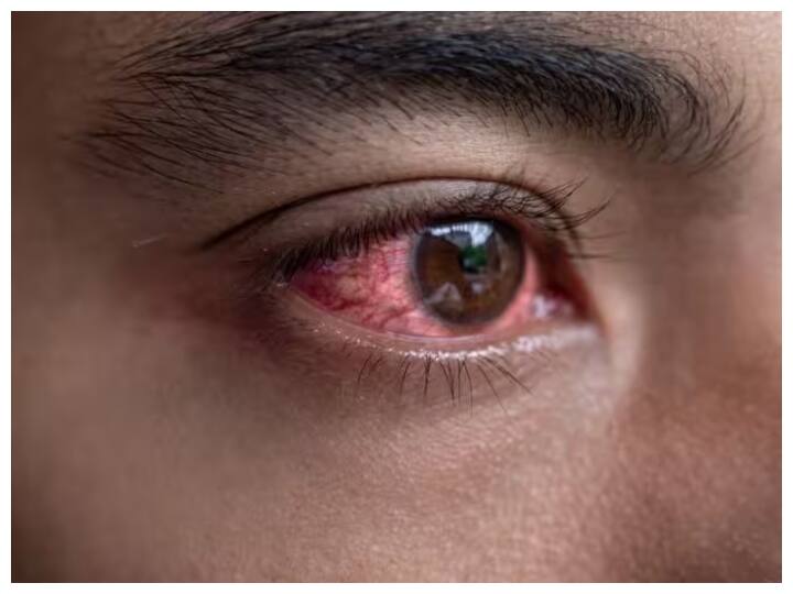 Health Tops: These 5 eye diseases are dangerous you can become a victim of blindness Eye Care: આંખોની આ 5 બીમારી છે ખતરનાક, અંધત્વનો બની શકો છો શિકાર
