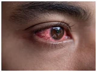 Eye Care: આંખોની આ 5 બીમારી છે ખતરનાક, અંધત્વનો બની શકો છો શિકાર