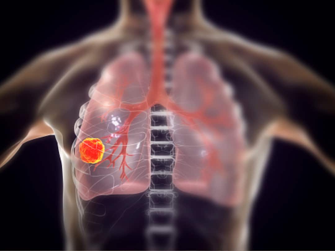 World Lung Cancer Day 2023: Some Early Signs Of Damage To Look For Due To Tobacco Consumption World Lung Cancer Day 2023: Some Early Signs Of Damage To Look For Due To Tobacco Consumption World Lung Cancer Day 2023: Some Early Signs Of Damage To Look For Due To Tobacco Consumption