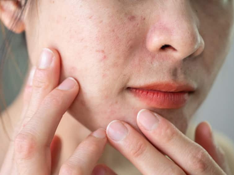 Know About Allergic Contact Dermatitis And Other Common Skin Issues During Monsoon