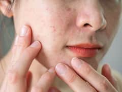 Know About Allergic Contact Dermatitis And Other Common Skin Issues During Monsoon