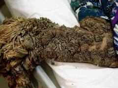 Viral News: ਅਜੀਬੋ-ਗਰੀਬ ਬਿਮਾਰੀ, ਹੱਥਾਂ-ਪੈਰਾਂ 'ਤੇ ਉੱਗਣ ਲੱਗ ਪੈਂਦੇ ਹਨ 'ਪੌਦੇ', ਹੋ ਜਾਂਦੀ ਹੈ ਖ਼ਤਰਨਾਕ ਬਿਮਾਰੀ, ਇਹ ਹੈ ਲੱਛਣ!