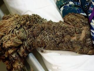 Viral News: ਅਜੀਬੋ-ਗਰੀਬ ਬਿਮਾਰੀ, ਹੱਥਾਂ-ਪੈਰਾਂ 'ਤੇ ਉੱਗਣ ਲੱਗ ਪੈਂਦੇ ਹਨ 'ਪੌਦੇ', ਹੋ ਜਾਂਦੀ ਹੈ ਖ਼ਤਰਨਾਕ ਬਿਮਾਰੀ, ਇਹ ਹੈ ਲੱਛਣ!