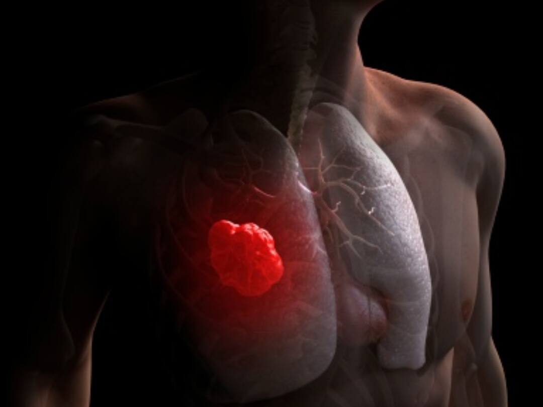 World Lung Cancer Day 2023: Can Passive Smoking Cause Cancer? See What Experts Say World Lung Cancer Day 2023: Can Passive Smoking Cause Cancer? See What Experts Say