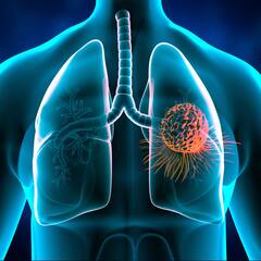 World Lung Cancer Day 2023: સાવધાન, માત્ર ધૂમ્રપાન જ નહીં, આ વસ્તુઓથી પણ થાય છે ફેફસાનું કેન્સર