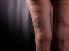 Cellulite Home Remedy : கொழுப்பு திசுக்கள் தென்படுகிறதா? இருக்கவே இருக்கு ஆலிவ் எண்ணெய்!