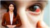 AI Anchor AIra Precautions For Conjunctivitis: కళ్లకలక లక్షణాలు, తీసుకోవాల్సిన జాగ్రత్తలు ఏంటి..?