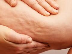 Cellulite Home Remedy : கொழுப்பு திசுக்கள் தென்படுகிறதா? இருக்கவே இருக்கு ஆலிவ் எண்ணெய்!